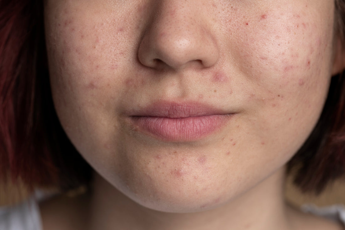 Why Your Skin Feels Dry, Sensitive & Tired — The Truth About Skin Barrier Damage